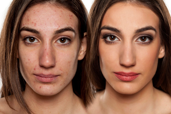 Comment cacher vos boutons d'acné ? Les tutos des Youtubeuses sont là pour nous sauver la vie...