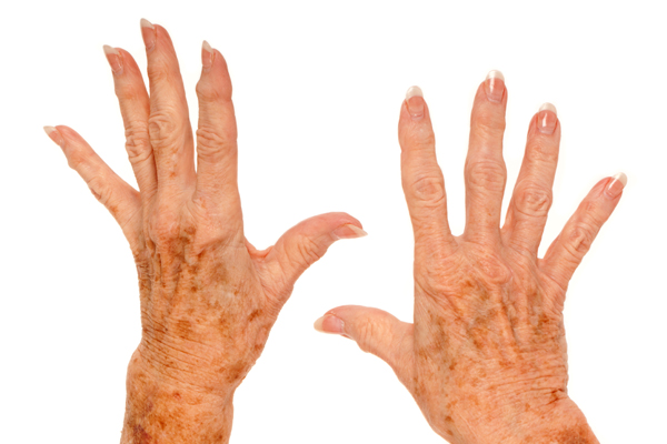 Taches de vieillesse (Istock)